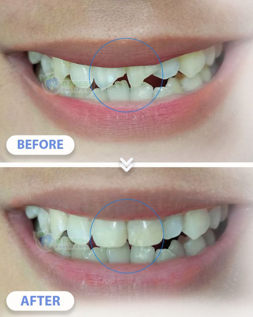 Tambal Gigi Depan #4 — hasil perawatan kasus 1 di B Fresh Dental Care