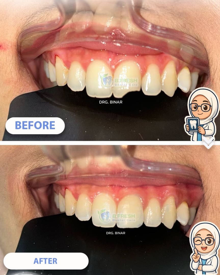 Tambal Gigi Depan #4 — hasil perawatan kasus 3 di B Fresh Dental Care