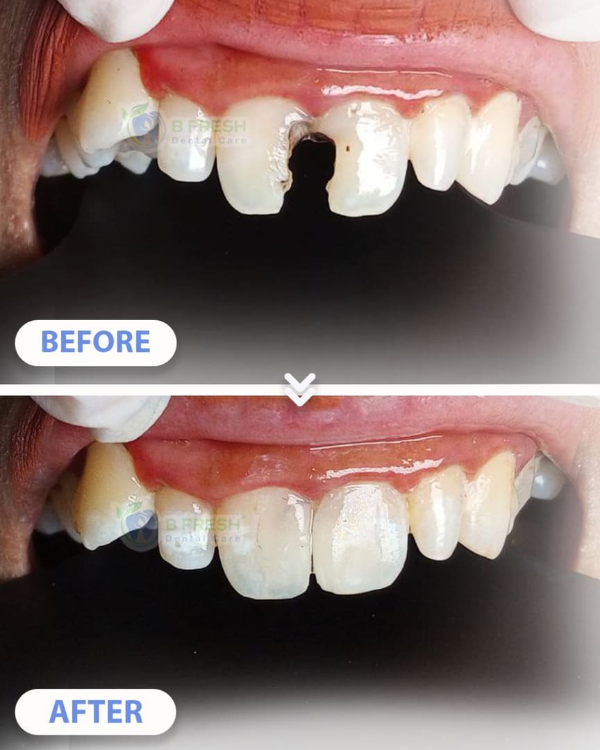 Tambal Gigi Depan #5 — hasil perawatan kasus 1 di B Fresh Dental Care