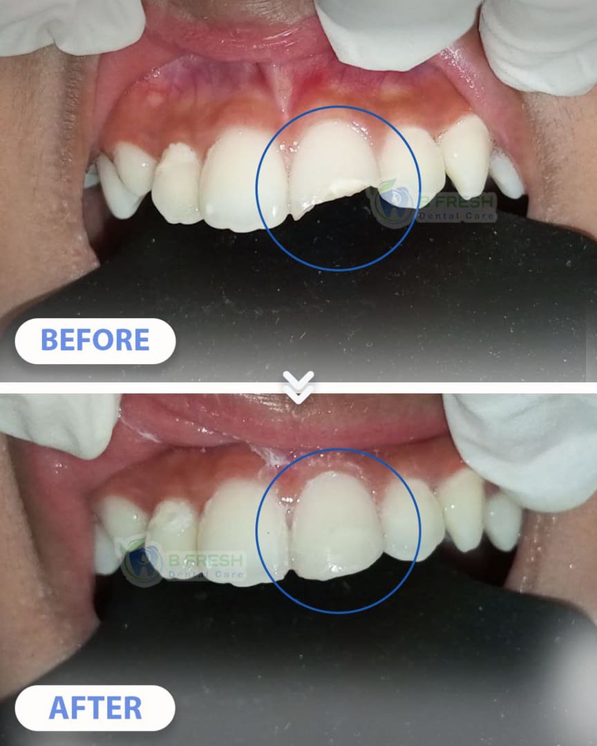 Tambal Gigi Depan #5 — hasil perawatan kasus 3 di B Fresh Dental Care