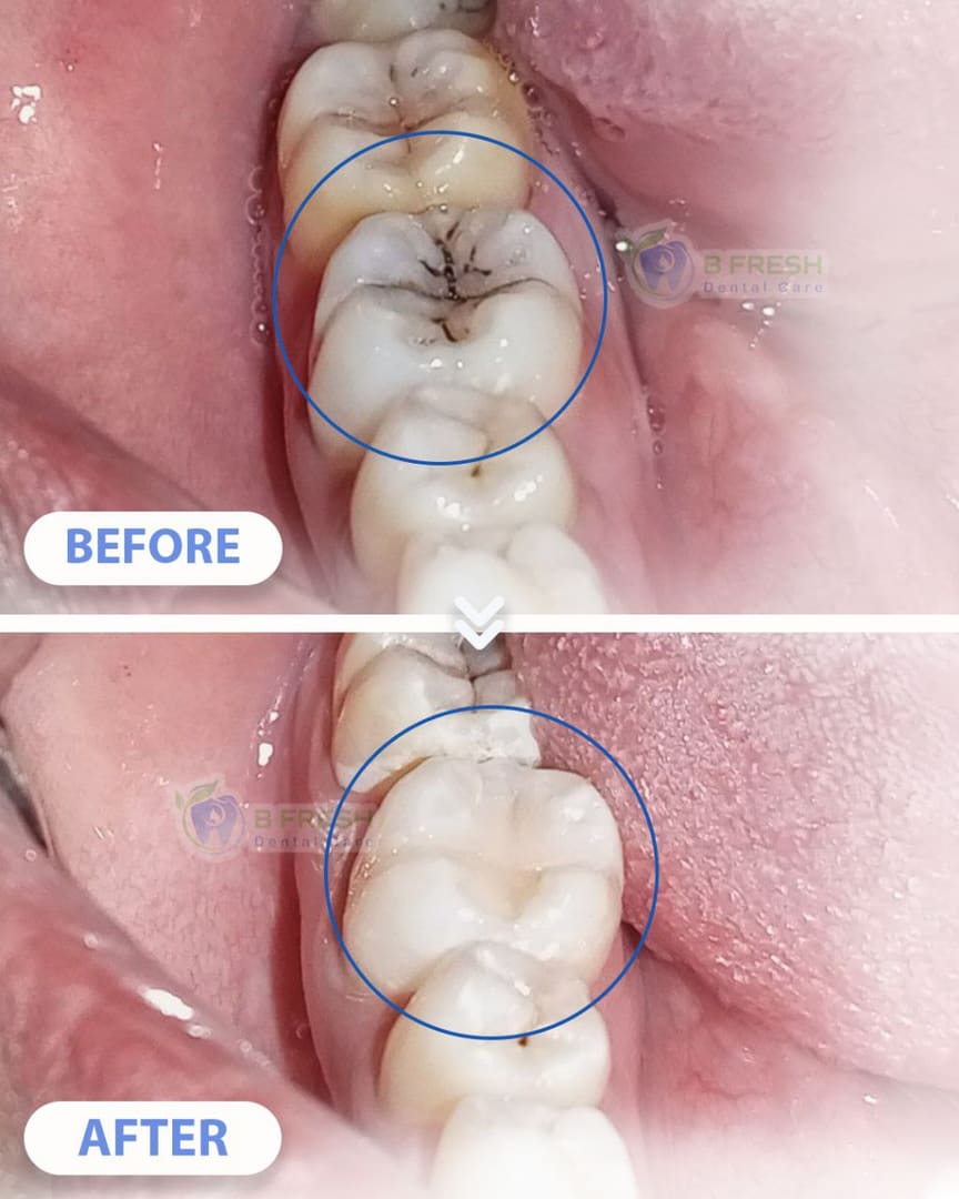 Tambal Gigi Belakang #6 — hasil perawatan kasus 1 di B Fresh Dental Care