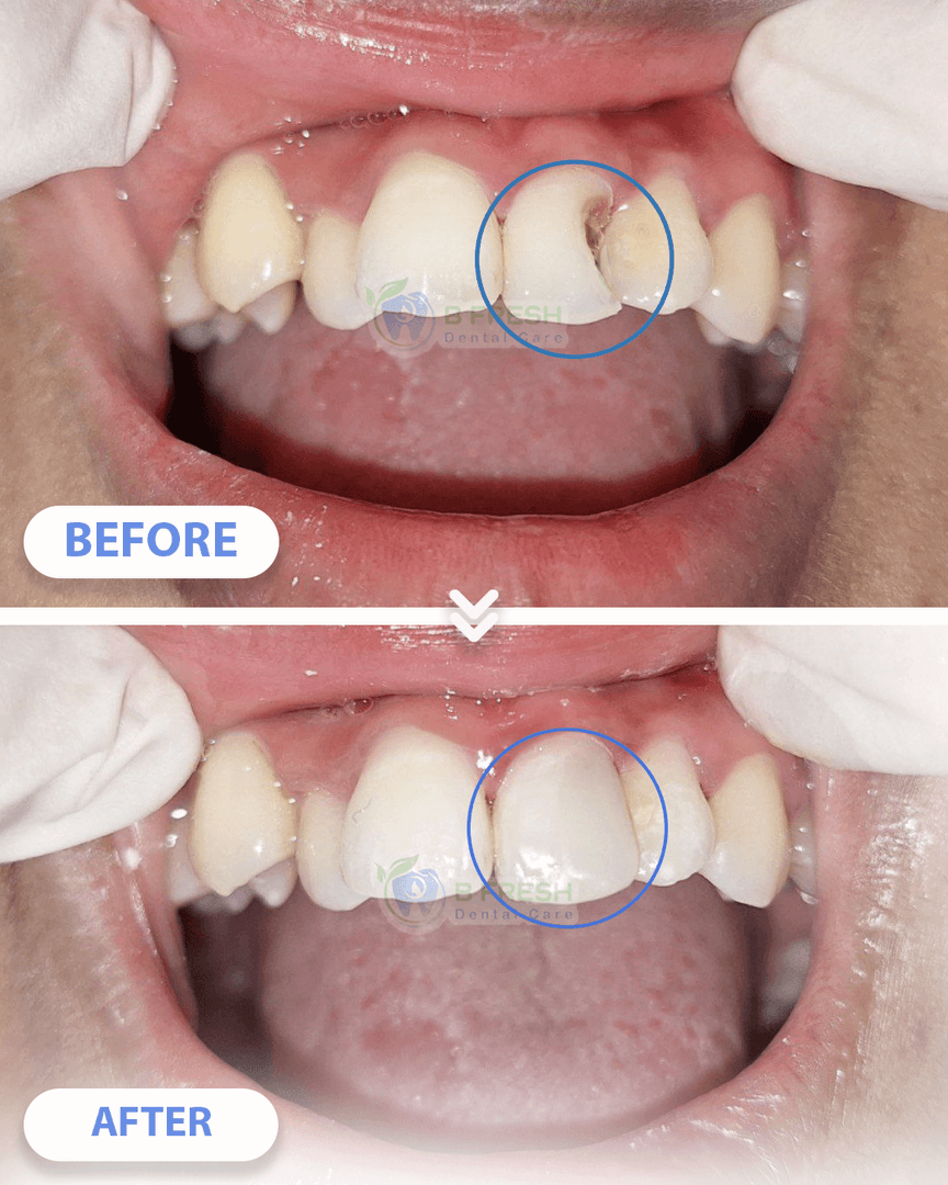 Tambal Gigi Belakang #6 — hasil perawatan kasus 3 di B Fresh Dental Care