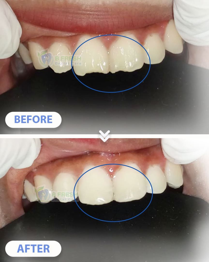 Tambal Gigi Depan #7 — hasil perawatan kasus 1 di B Fresh Dental Care