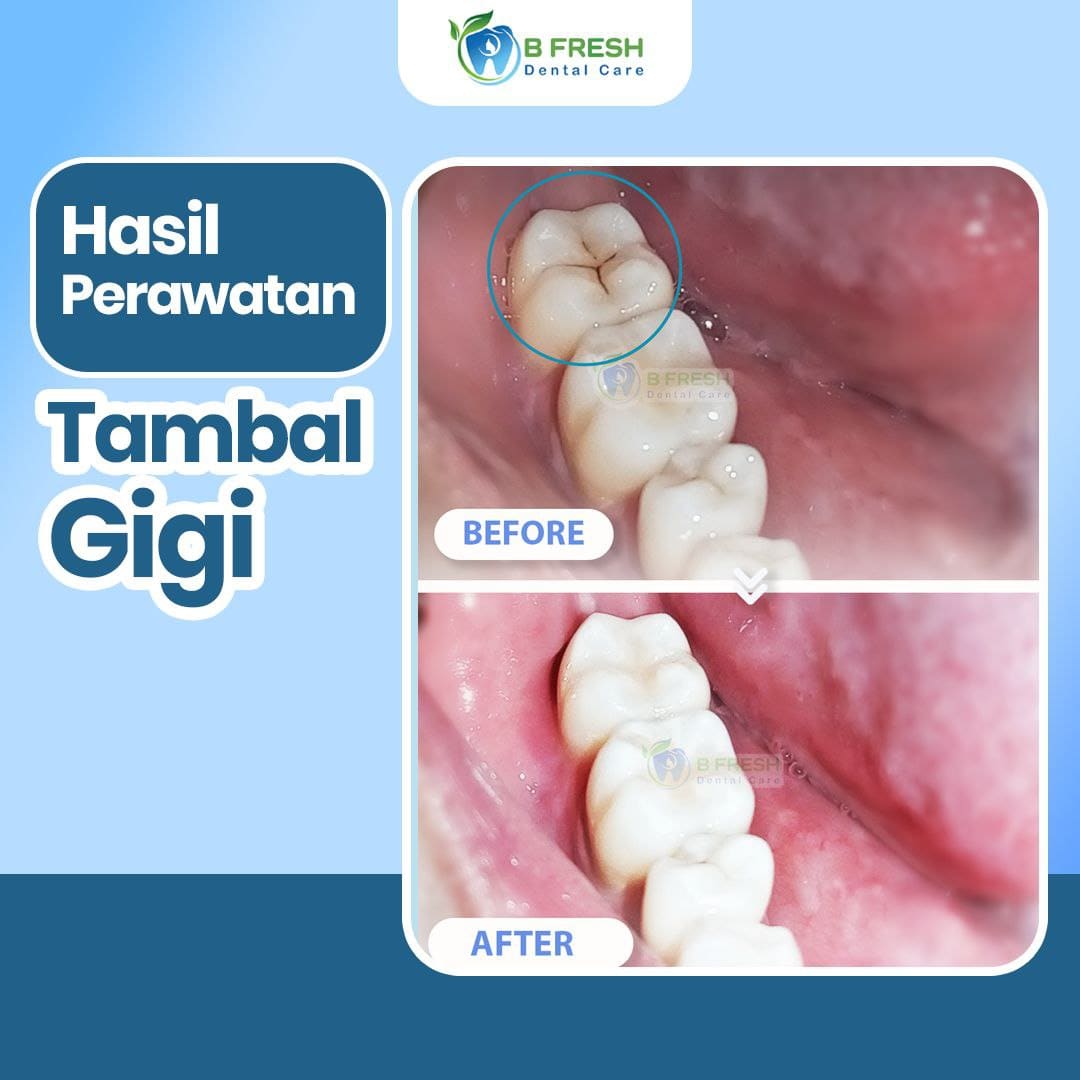 Tambal Gigi Belakang #8 — hasil perawatan kasus 1 di B Fresh Dental Care