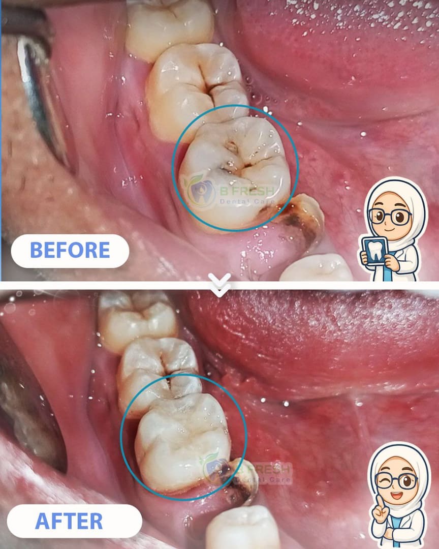 Tambal Gigi Depan #9 — hasil perawatan kasus 3 di B Fresh Dental Care