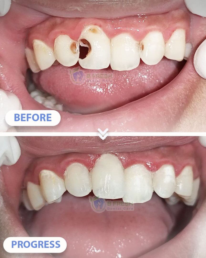 Tambal Gigi Depan #1 — hasil perawatan kasus 2 di B Fresh Dental Care