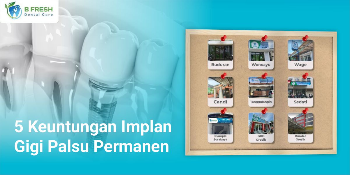Implan Gigi Palsu Permanen: 5 Keuntungannya