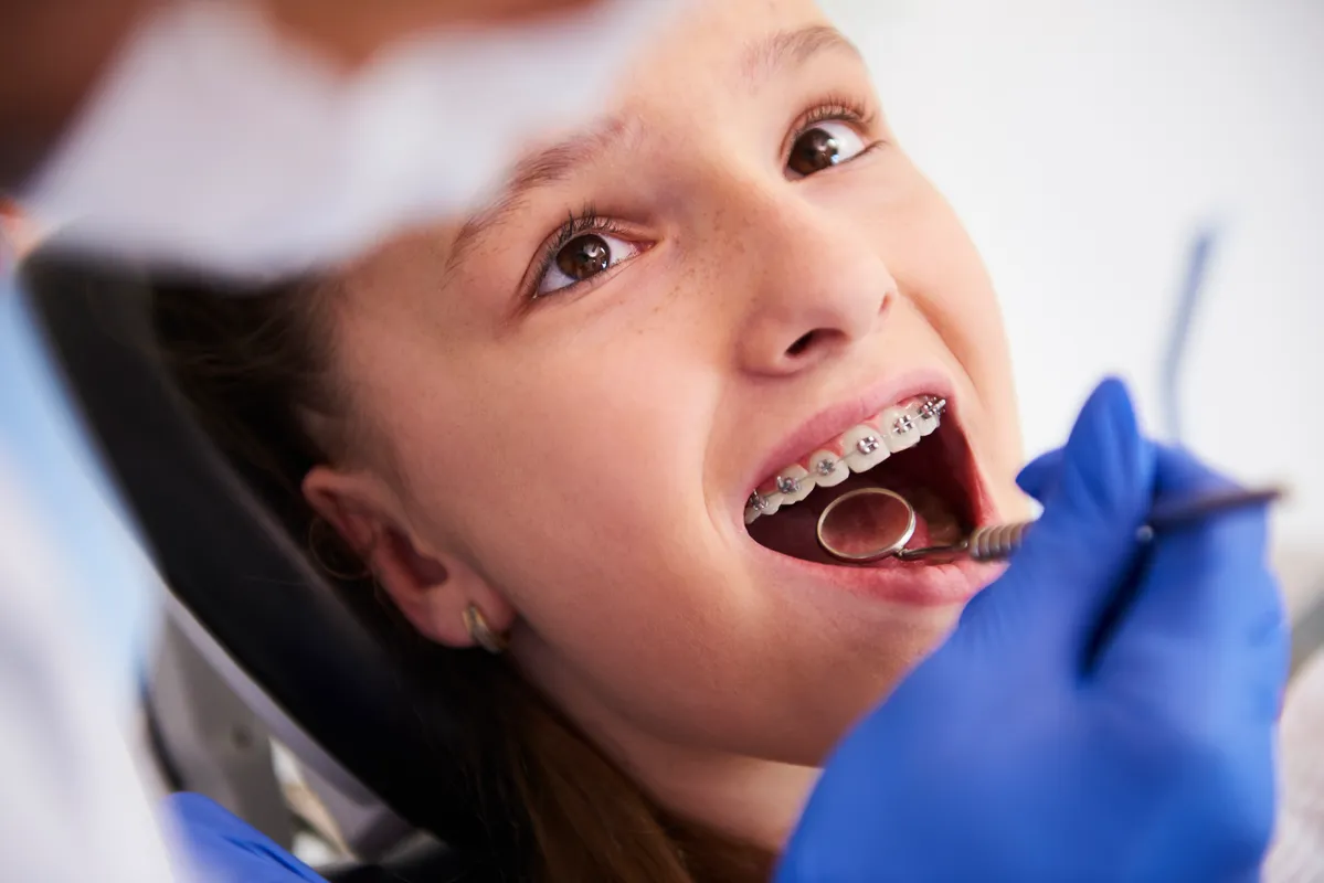 Kenapa Pasang Behel di B Fresh Dental Care?