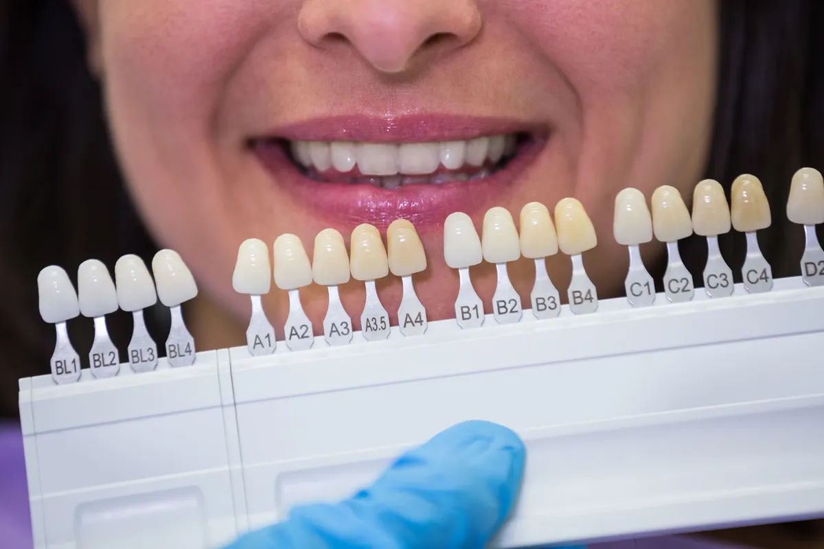 Mengenal Veneer Gigi: Prosedur Dan Manfaatnya