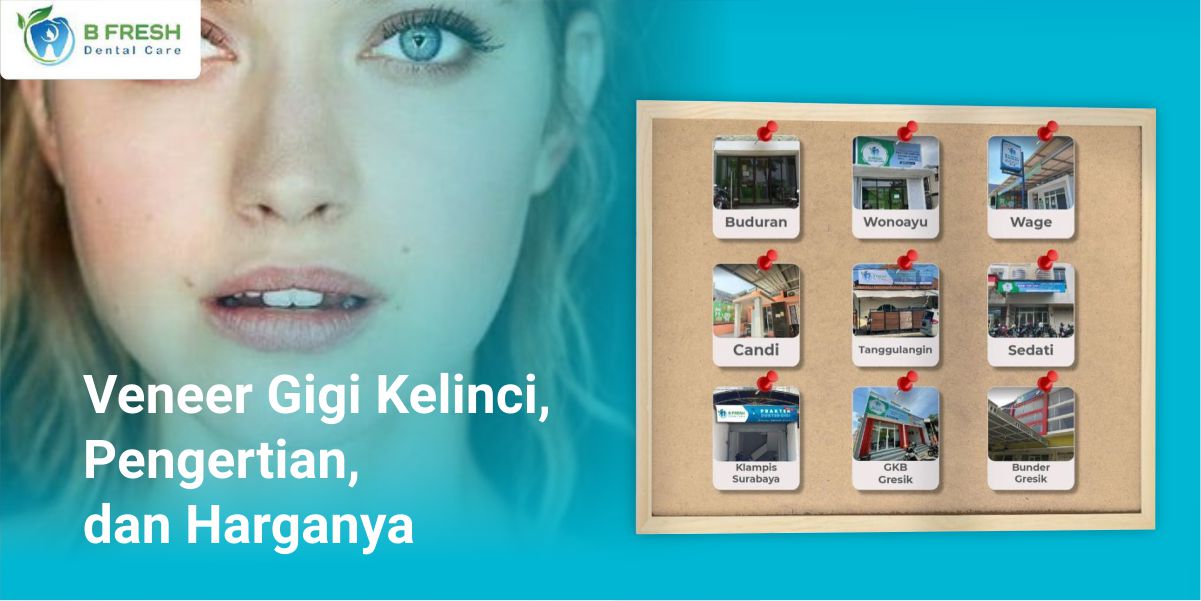 Veneer Gigi Kelinci, Pengertian, Dan Harganya
